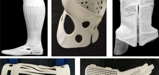 3d printed orthosis_No.9 hospital 3